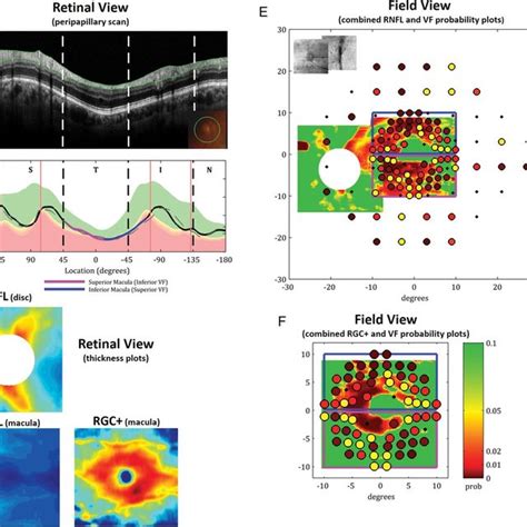 Visual Field Vf And Spectral Domain Optical Coherence Tomography