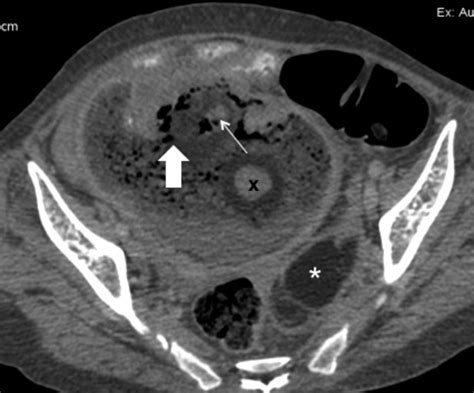 Axial Cect Shows A Large Adenexal Mass With Predominantly Fat