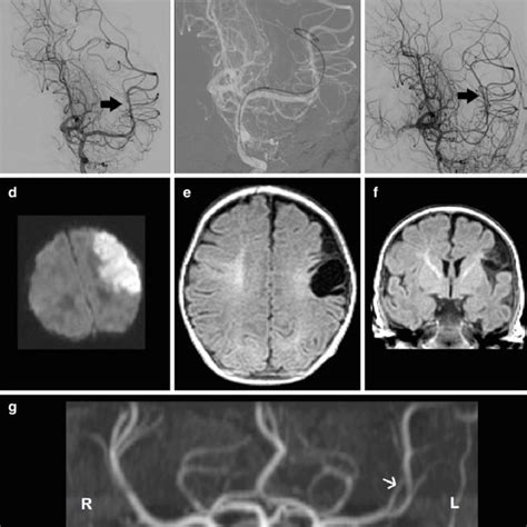 A Digital Subtraction Angiography Dsa Occlusion Of The M2 Branch Of Download Scientific