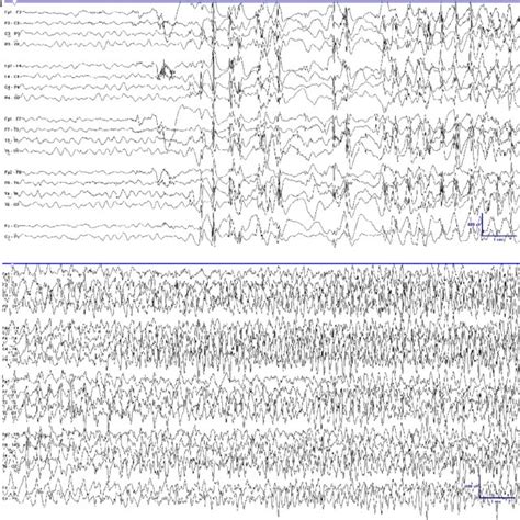 Postictal unilateral EEG suppression after a provoked, secondarily... | Download Scientific Diagram