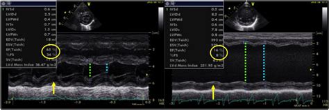 Low Normal Lv Systolic Function Semashow