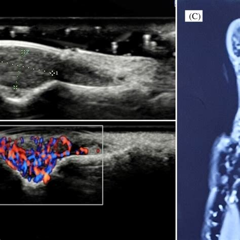 A Photomicrograph Showing Well Circumscribed Lesions With Surrounding