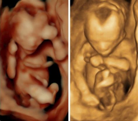 Weeks Pregnant Ultrasound Gender