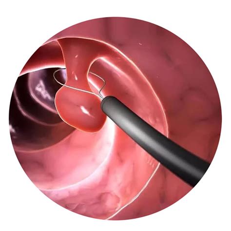 High Quality EMR EDS Instrument Polypectomy Cold Snare for Single Use ...