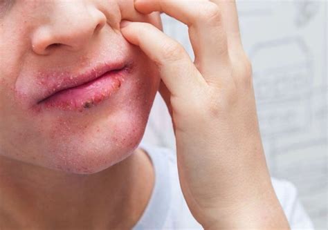 Dermatitis Atópica Cómo Cuidar Tus Labios Natursan