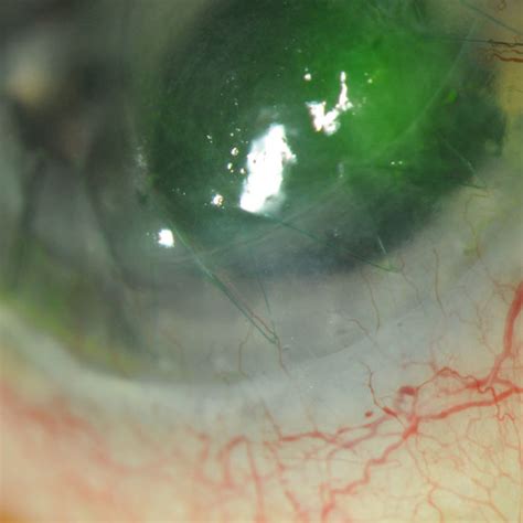 Geographic Corneal Ulcer Involving The Graft Host Interface Download Scientific Diagram