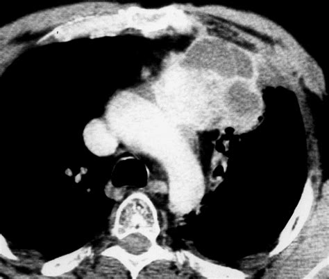 Imaging Of Cystic Masses Of The Mediastinum RadioGraphics