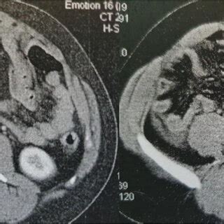 Contrast-enhanced CT findings Axial images of contrast-enhanced CT on... | Download Scientific ...