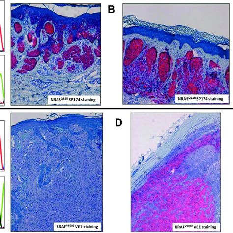 Braf V E Ve Staining In Naevus Associated Melanoma Concordant