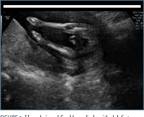 Caudal Regression Syndrome Ultrasound