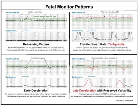 Fetal Heart Rate Patterns Explained Fhr 101 Fetal Monitor Patterns