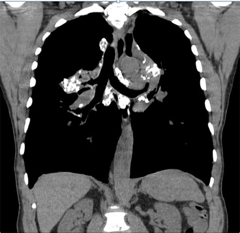 Coronal Ct Image Of A Year Old Male Patient With Silicosis And Pmf