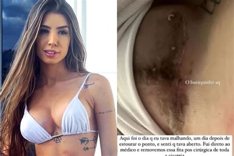 Maria Lina Exp E Buraco Em Cicatriz Do Silicone E Admite Culpa