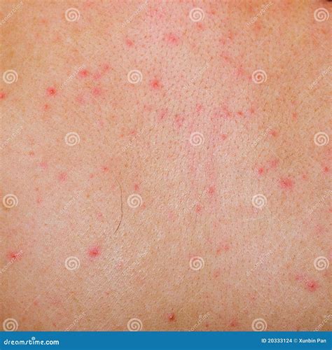 Dermatitis Rash Pictures Photos