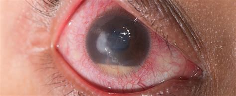 Common Eye Conditions