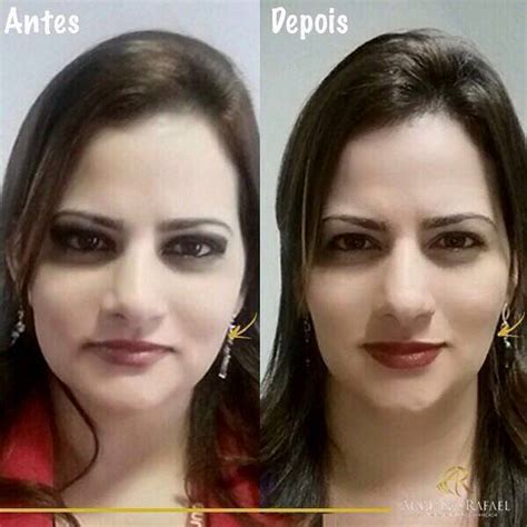 Botox Before And After Face (12) » Facelift: Info, Prices, Photos ...