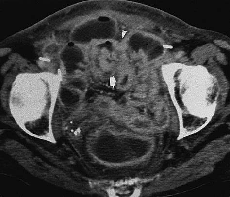 Ct Evaluation Of Small Bowel Obstruction Radiographics