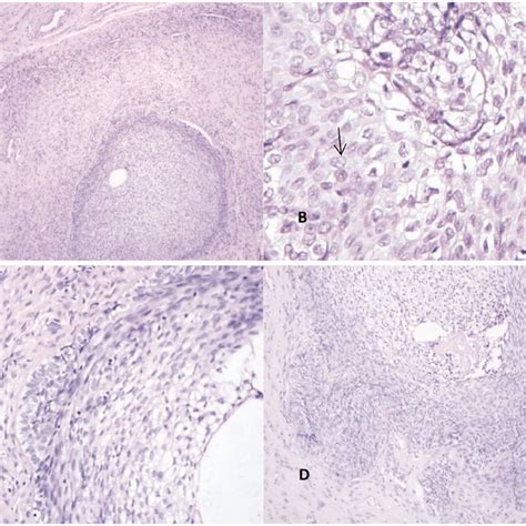 Immunohistochemistry Findings A Epithelial Tumor Cells Are Diffusely