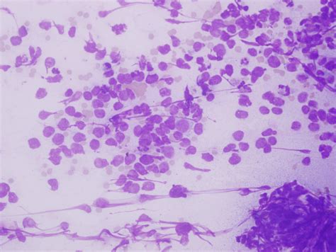 Pathology Outlines Merkel Cell Carcinoma