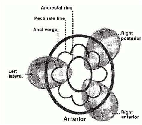 Hemorrhoids Abdominal Key