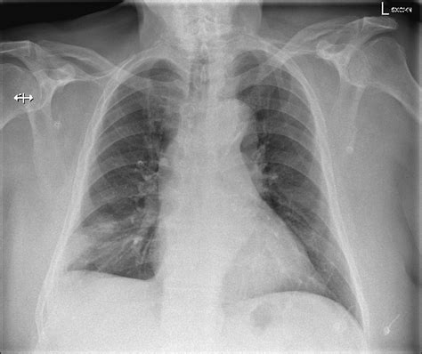 Pulmonary Infarction Radiology Reference Article