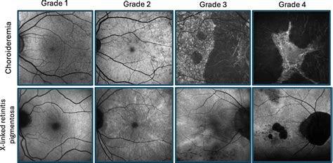 Frontiers Retinal Vascular Reactivity In Carriers Of X Linked