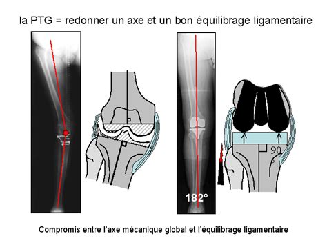 Prothèse Du Genou Chirurgie Du Genou Et De La Hanche