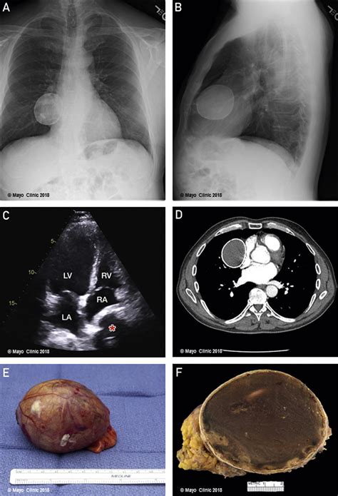 A Symptomatic Calcified Pericardial Cyst Mayo Clinic Proceedings