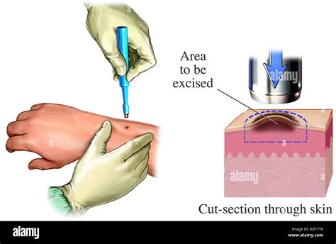 Biopsy Stock Photos Biopsy Stock Images Alamy