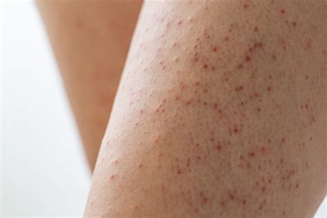 Keratosis Pilaris Armoraa