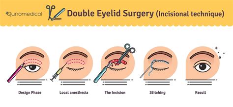 Blepharoplasty Costs In The Uk And Abroad Qunomedical