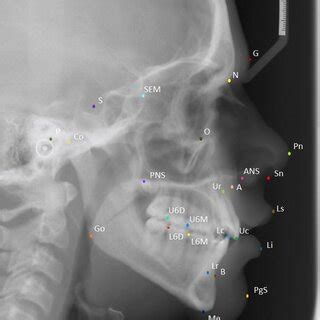 A sample cephalometric X-ray showing the true positions of the 26 ...