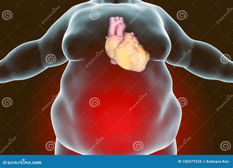 Heart Disease In Obesity Person Stock Illustration Illustration Of Problem Background 105371525