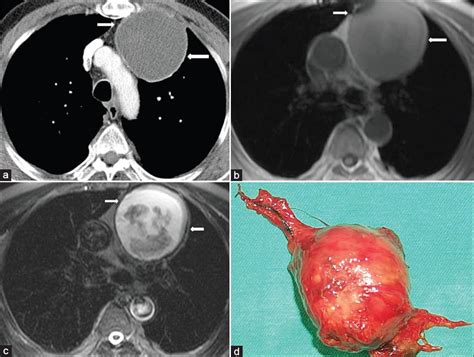 Imaging Of Cystic And Cyst Like Lesions Of The Mediastinum With Pathologic Correlation Journal