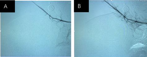 A Pre Embolization And B Post Second Embolization On Right Download Scientific Diagram