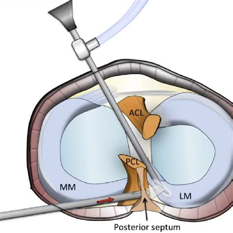 Transeptal Approach Illustration Acl Anterior Cruciate Ligament Lm