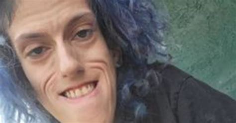 Woman With Facial Deformities Hits Back At Evil Trolls Who Flood Her