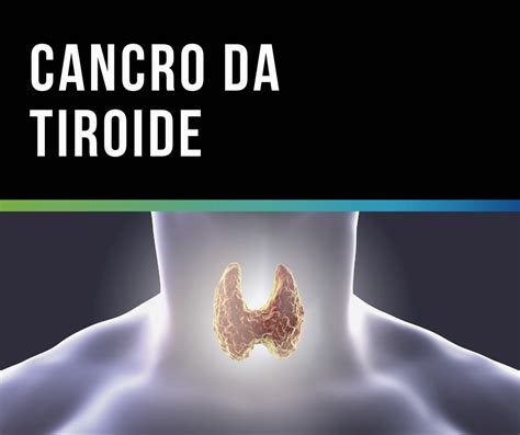 Cancro Da Tiroide Novos Factores De Risco O Seu Otorrino Tiago