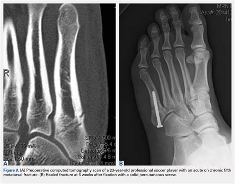 Foot And Ankle Injuries In Soccer Mdedge Surgery