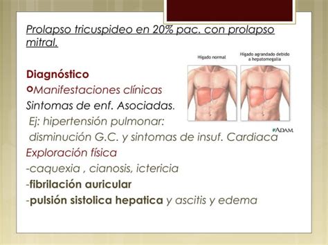 Valvulopat A Mitral Y Tric Spide Ppt