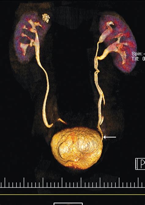 CT urogram showing duplex (i.e., with double ureters) left kidney. The... | Download Scientific ...