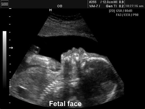 Ultrasound Images • Fetal Face B Mode Echogramm №192