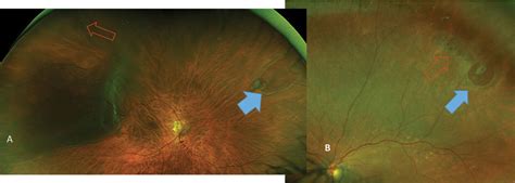 Atrophic Retinal Hole - A Pictures Of Hole 2018