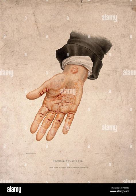 A Hand With A Skin Disease On The Palm And Wrist Coloured Lithograph