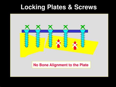 PPT Locking Plates Advantages Indications PowerPoint Presentation