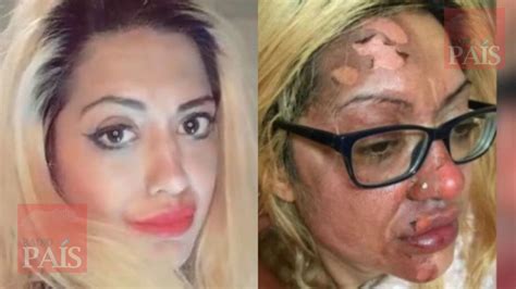 Mujer Sufre Graves Quemaduras En Su Cara Por Hacer Un Reto Viral De