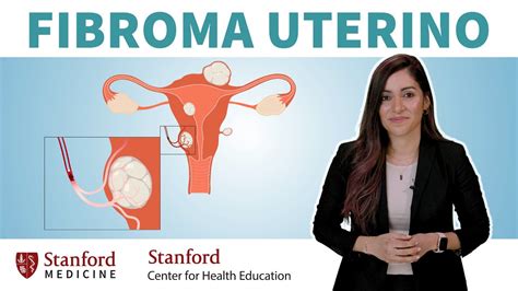 Fibromas Uterinos Sintomas Causas Y Tratamientos Stanford YouTube