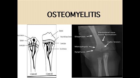 Acute Osteomyelitis Youtube