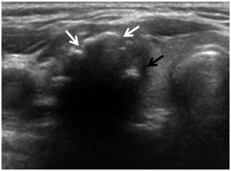 Malignant Thyroid Nodules Ultrasound