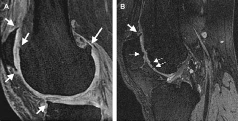 Osteophyte Imaging A Sagittal 3d Gre Image Shows Well Delineated Download Scientific Diagram